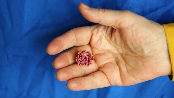 体内有癌，双手知道？手上出现5个变化，小心是肝癌、肺癌、癌王的信号！