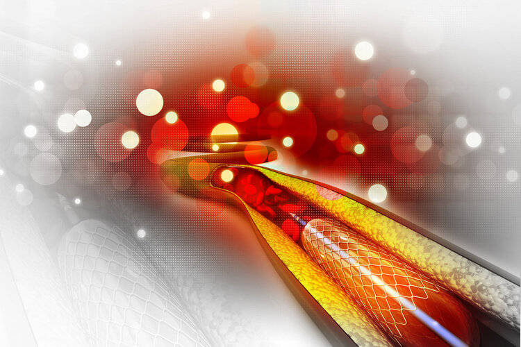 原创            大骗局：心脏支架在国外被淘汰多年？做完人就废了？告诉您真相