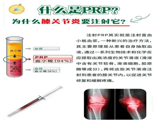 【汤医科普】PRP（富血小板血浆）膝关节注射术后护理