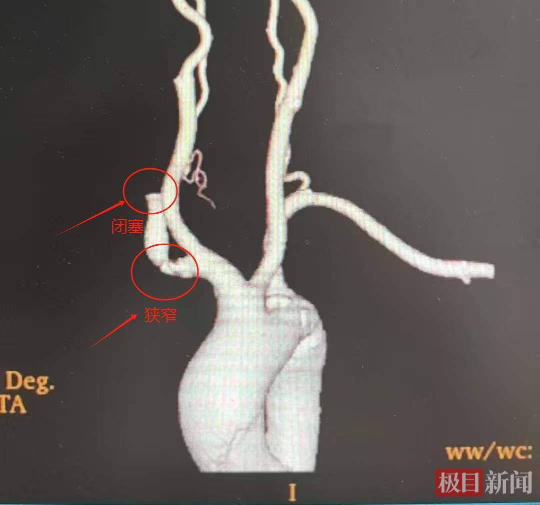 女子单臂测血压险患大病，医生提醒首次测量务必“左右开弓”