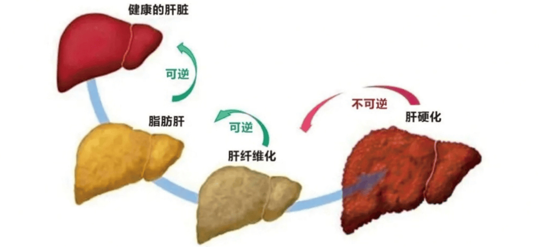 “国际”科普｜吃出“干净”人生，3类食物让脂肪肝主动退散