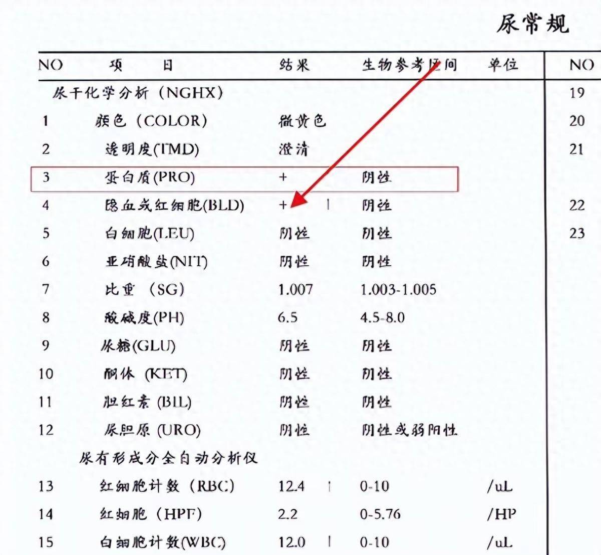 容不容易肾衰竭，先查尿常规！医生坦言：70岁后，3个指标要留意