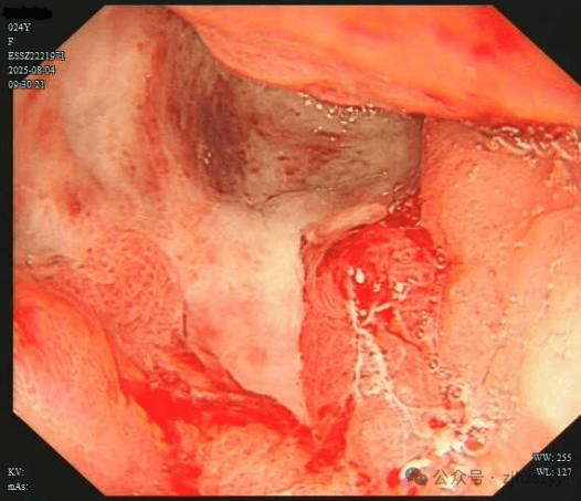 24岁女演员确诊“癌王”，崩溃痛悔：大家别像我这样