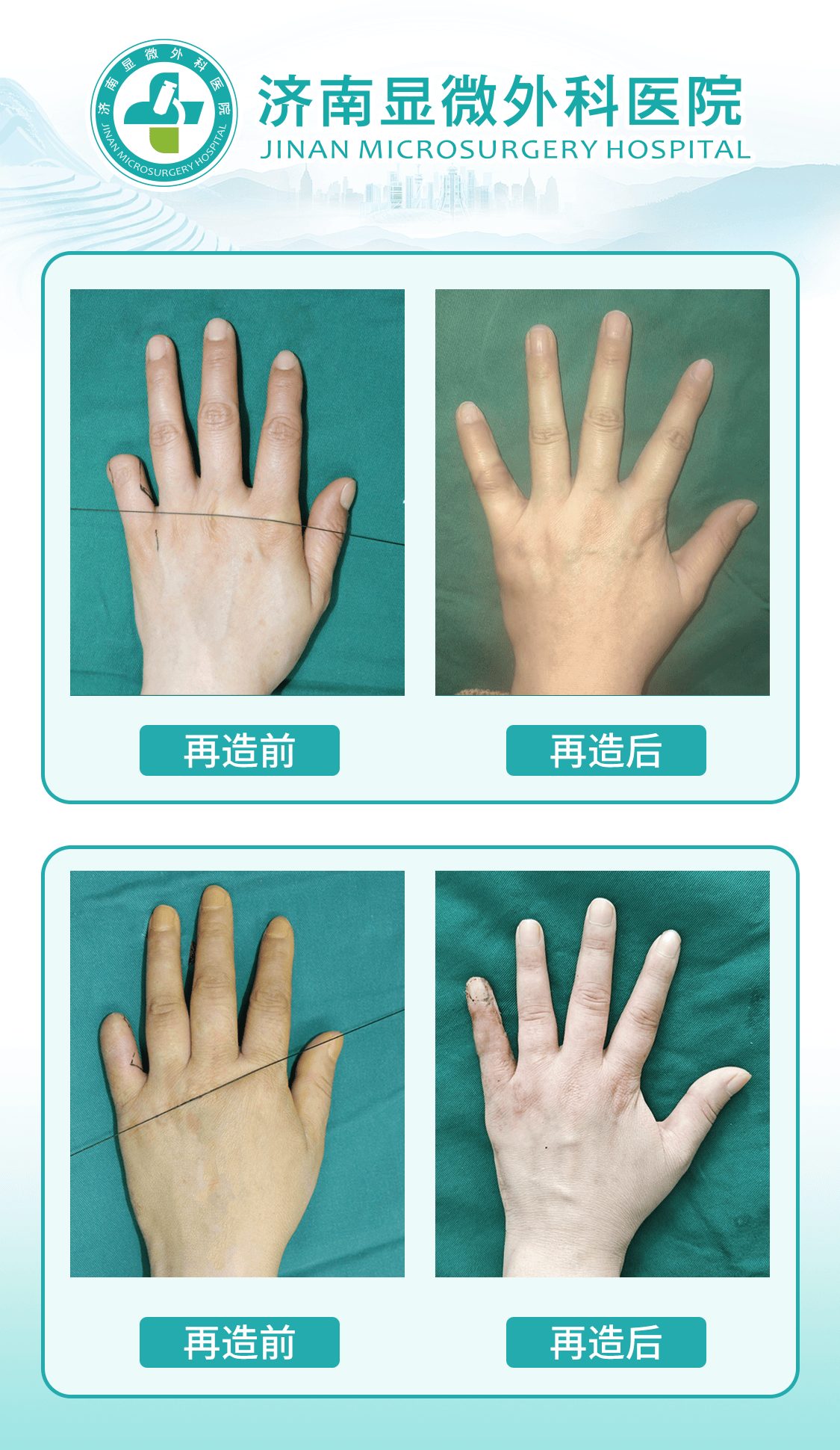 手指断了多年怎么接？黄威手指再造中心