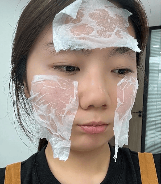 扁平疣治愈记：脸蛋变光滑的快乐