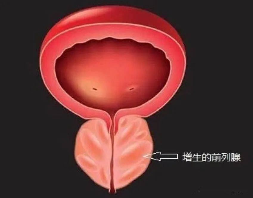 不开刀解“男”言之隐！钬激光微创术，轻松应对前列腺增生
