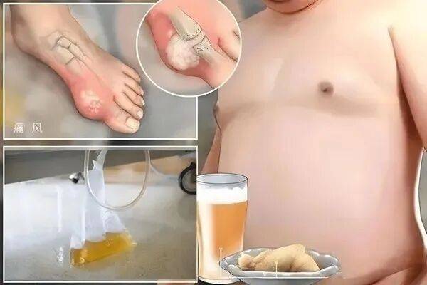 尿酸降了又复发？排泄不畅用三个办法，痛风专家周桂兰教你几招！