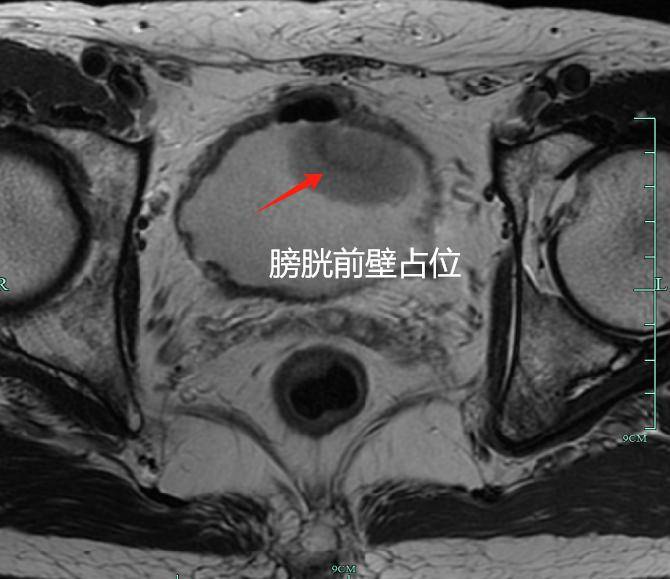 不痛不痒，要切除重要器官？男子悔惨：这里长肿块90%是恶性癌！