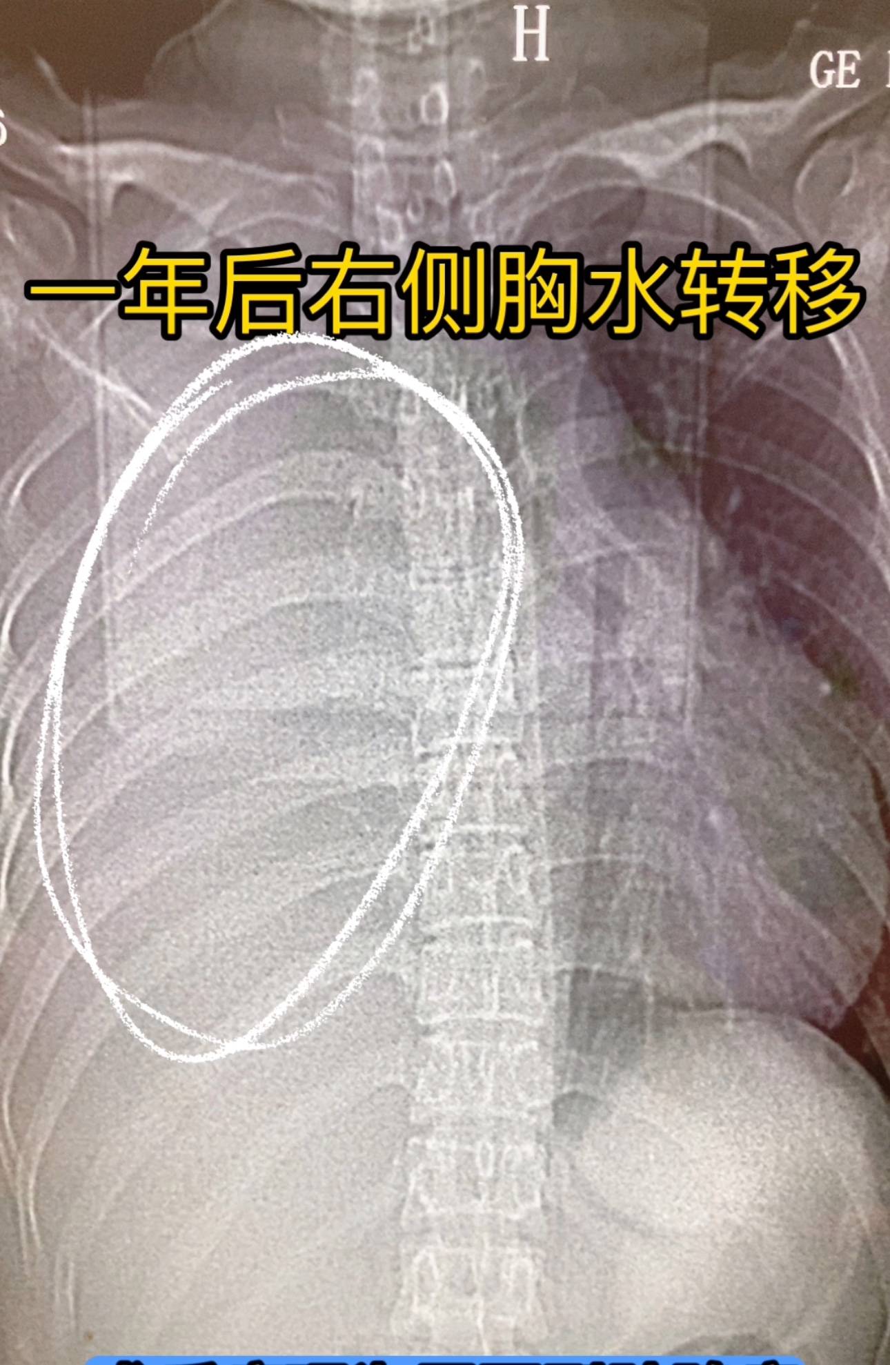 右下肺肿块 三期 一年后转移