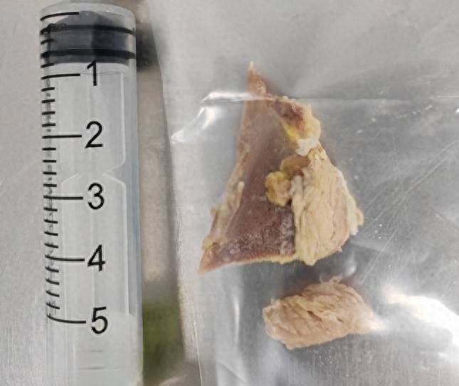 离主动脉仅约1毫米！吃饭时一个疏忽，让她差点命悬一线