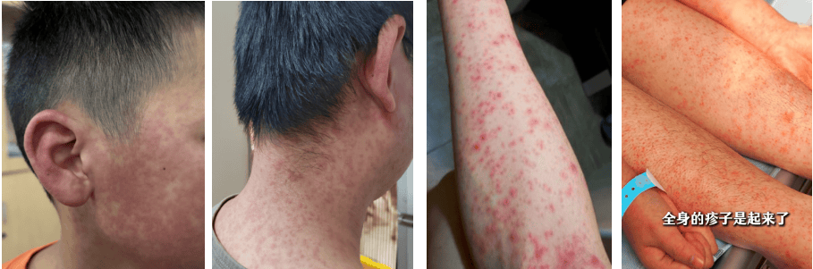 无特效药可治！家家户户点蚊香！广东一地发布基孔肯雅热后遗症告知书