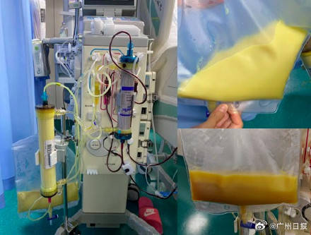 27岁女子每天3杯奶茶 血液像猪油