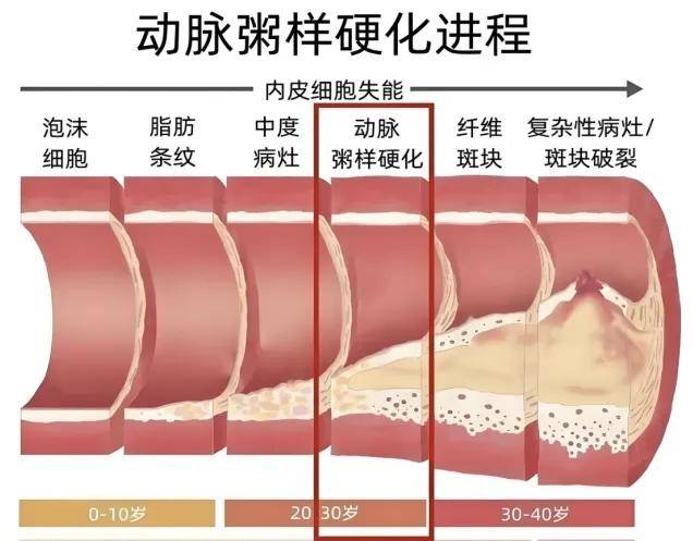 【健康科普】我们的血管为什么会生病？