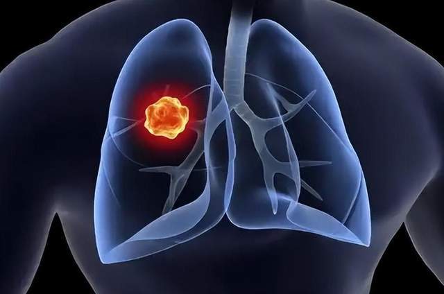 原创            肺癌高发人群自查手册：这5类高发人群做好预防，早期筛查能救命