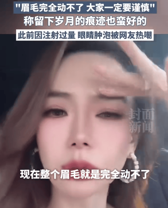 戚薇大方承认医美过度：打僵了，整个眉毛完全动不了