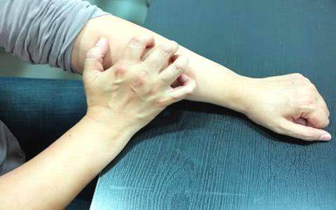 夏季有荨麻疹，做好养治结合扫除烦恼