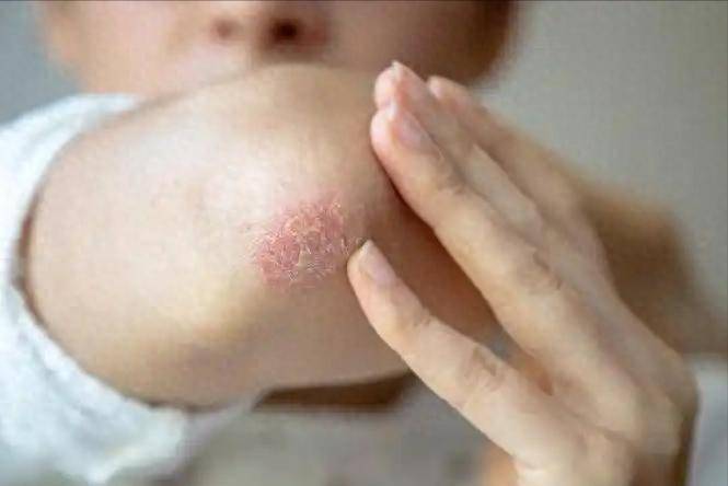 我国湿疹患者越来越多？医生劝告：这些东西，或许是“罪魁祸首”