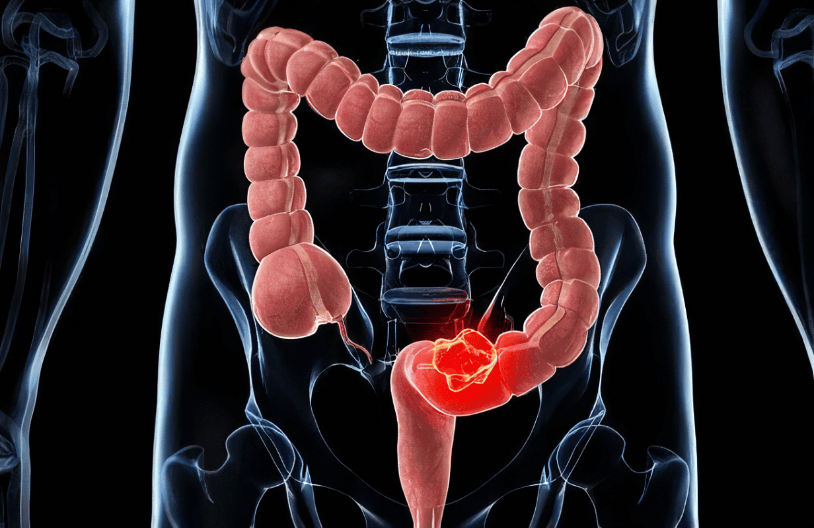 警惕结直肠癌前病变，常规体检不能替代专项筛查