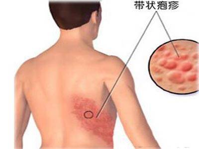 【健康科普】春季警惕“缠腰龙”——带状疱疹的科学防治