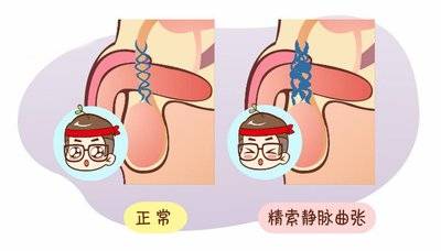 精索静脉曲张手术步骤