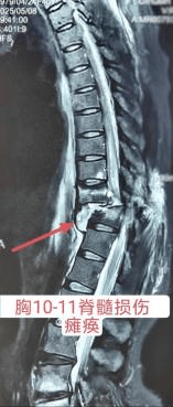 原创            完全性脊髓损伤瘫痪真的没法改善吗？