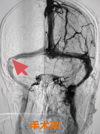 五年顽固耳鸣一朝消！北京老年医院成功开展首例脑静脉窦支架术→