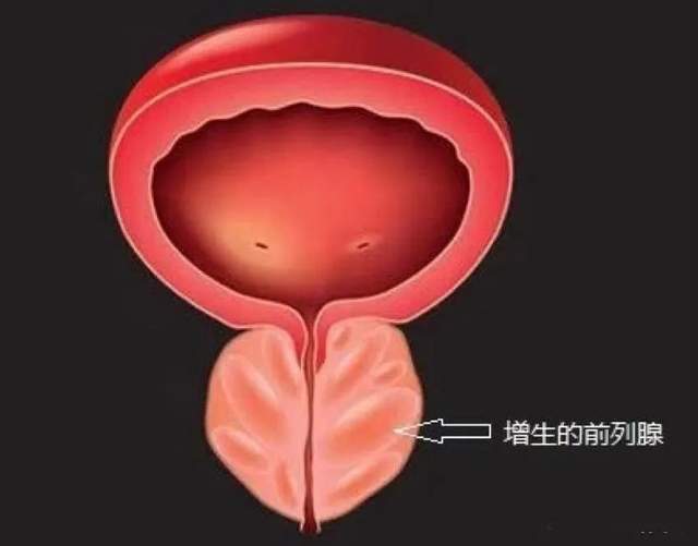 不开刀解“男”言之隐！钬激光微创术，轻松应对前列腺增生