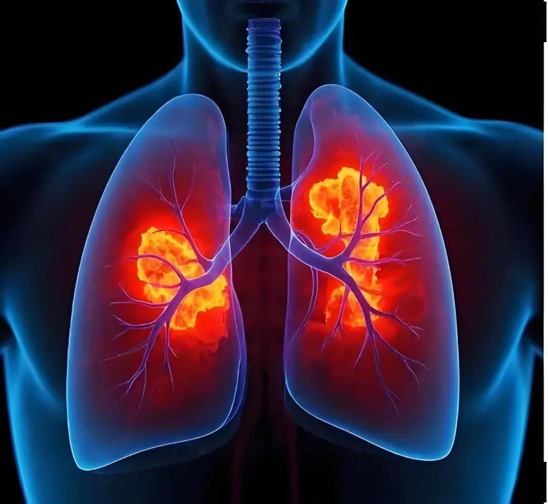 复旦团队破解肺腺癌免疫抑制关键机制，为个性化治疗开新窗