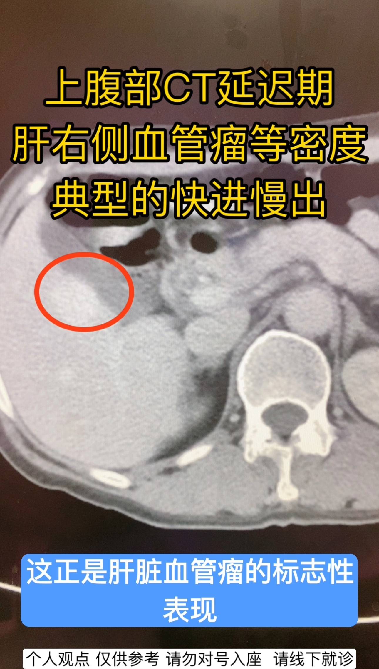 体检发现 肝脏右叶占位 上腹部增强CT