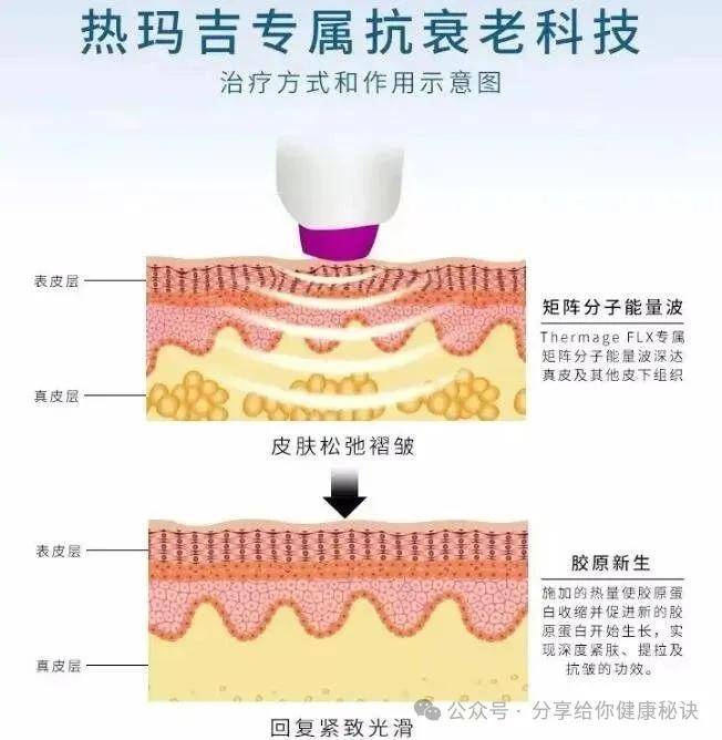 美丽助手：热玛吉是什么美容，热玛吉的价格一般是多少