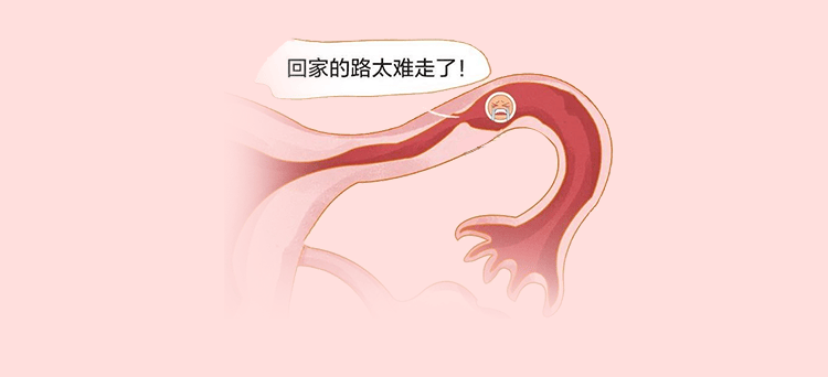 输卵管通而不畅：到底是堵了还是没堵？