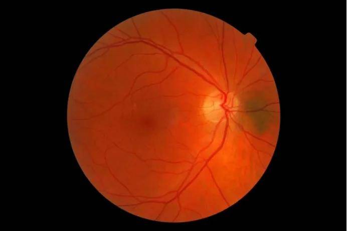 宁波鄞州眼科专家杨柳主任带你认识黄斑病变