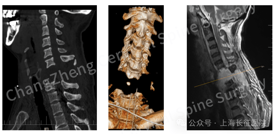 “颈椎已离断式脱位”，中国医生救回“身首离断”患者