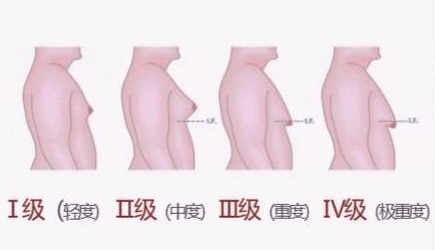 男性乳腺发育程度分级：精准认知与健康管理