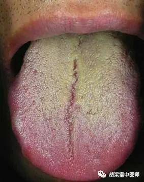 舌苔越厚，则体内的粘痰和炎症越多,清热利湿法可治