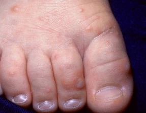 怎么看宝宝是否感染了手足口，该怎么办？