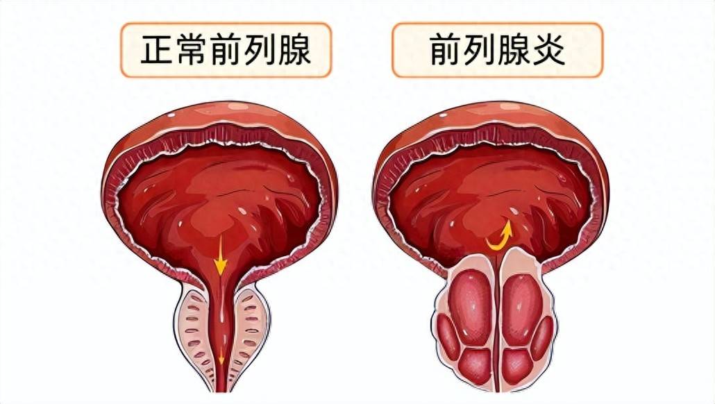 尿频、下腹坠胀？年纪轻轻就中招的“男”言之隐，你可能正在经历