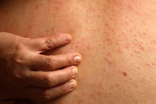 5个中成药：对不同类型皮炎，清热祛湿、祛风止痒，改善皮肤状态