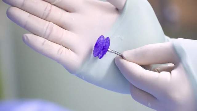 头痛顽疾竟因心脏有“小洞”，完全可降解封堵术破解难题