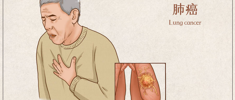 肿瘤患者喝中药后咳痰变多？普济中医李久泉：别慌！可能是身体在 “排毒”