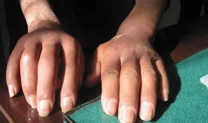 八年硬皮病患者给出建议，坚持吃它，不出一个月，皮肤有了明显的改善