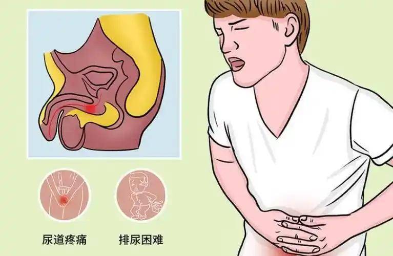 精囊炎在家怎么治？家庭护理措施详解