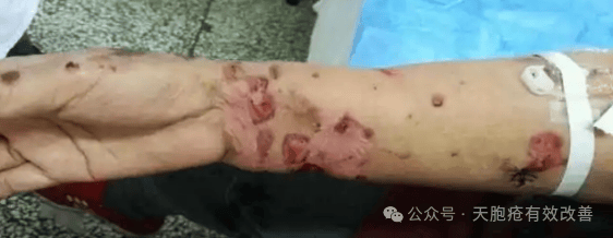 天疱疮的中医调理：健脾祛湿方剂的疗效与案例