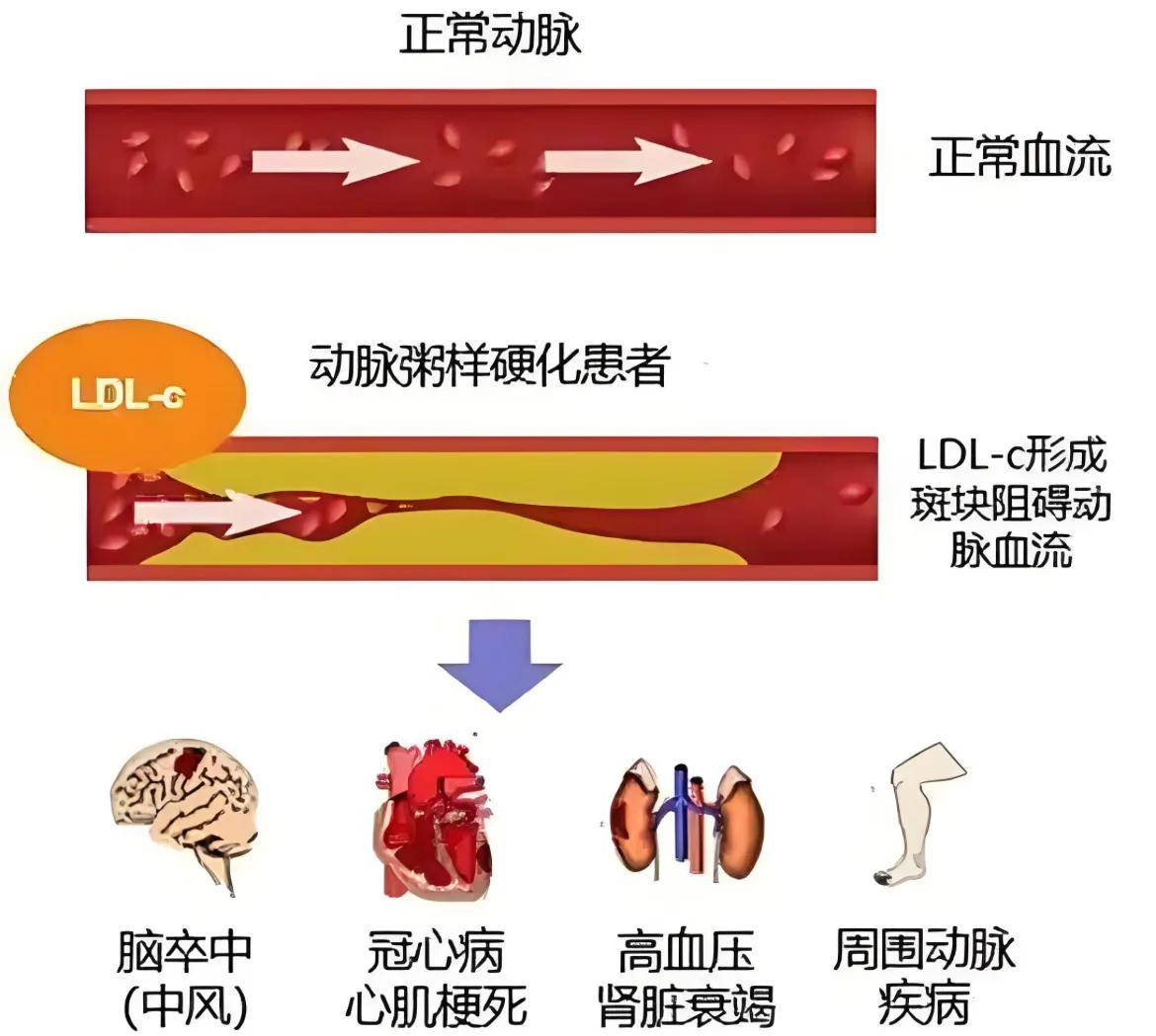 动脉粥样硬化新突破！2025全维度血管干预方案公开，三高患者有救了！