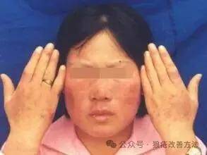红斑狼疮有转机！古方健脾祛湿，十日见证肌肤焕新