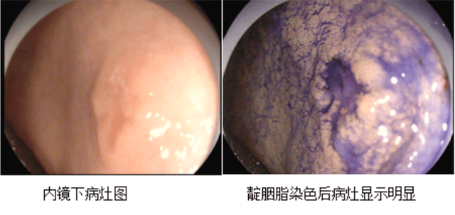 72岁老人胃里发现“早癌”，一个“超级微创”手术轻松解决！