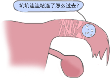 上海祝秀英医生：输卵管粘连了，还有机会自然怀孕吗？