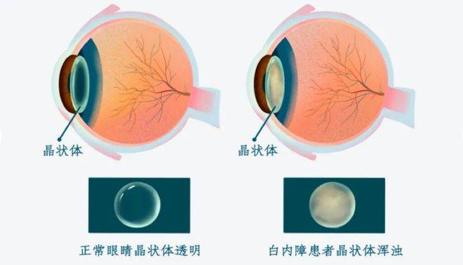 春夏秋冬，白内障手术有季节要求吗？