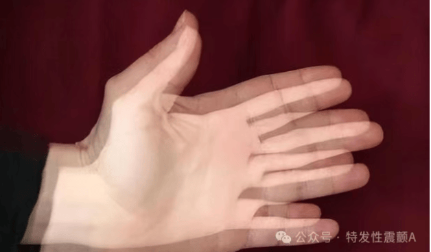 特发性震颤：一种易被忽视的 “良性震颤”