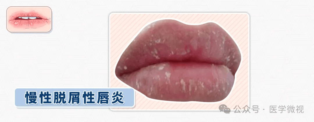 秋冬唇炎自救指南：告别干裂起皮，别再舔了！